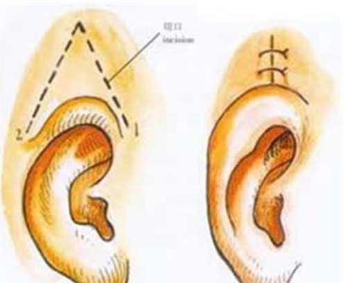 毛小炎耳再造怎么样？技术分析 | 收费价目表2026分析！插图