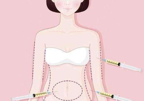 上海九院林晓曦脂肪填充好吗？深扒技术+2026新版价格表插图1