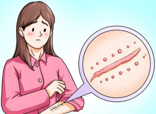 上海九院刘伟医生瘢痕修复怎么样？烧伤后关节部位瘢痕功能重建手术！插图2