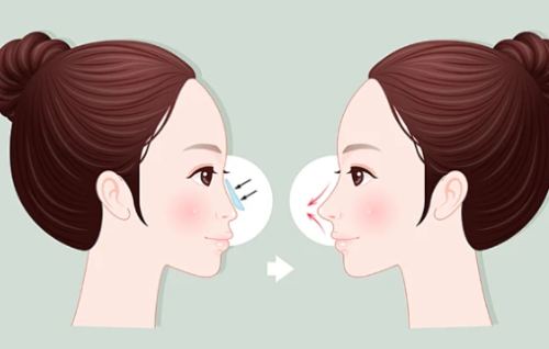 王先成做鼻子多少钱？收费区间、影响价格的关键因素全说明插图