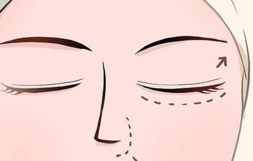 田忠建做双眼皮稳吗？从对称度、持久性到修复率来判断插图