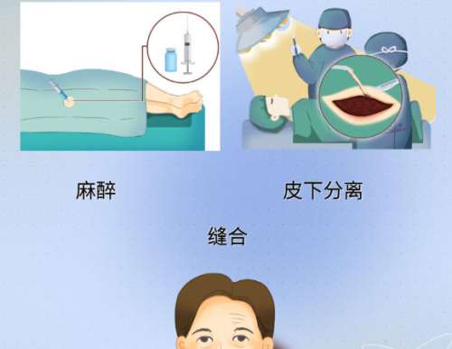 广州陈兵拉皮手术能维持几年需要多少钱？价格及客户口碑附上！插图3