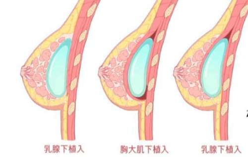 娄亮亮医生怎么样？胸部整形插图4