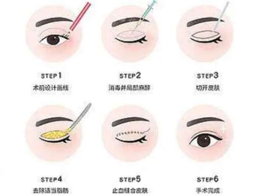 天津王文迪做双眼皮价格怎么样？收费明细与口碑点评插图