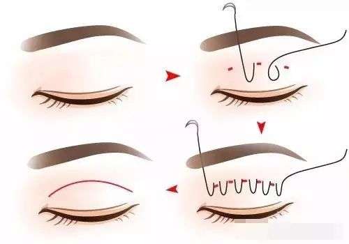 潍坊王少华双眼皮案例_审美与技术测评，风格自然\价格4千元起插图