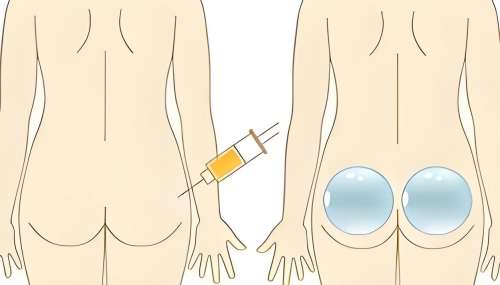 黄佳涌假体臀怎么样？四川华美形体精雕技术院长_审美在线，3-8万元不等插图1