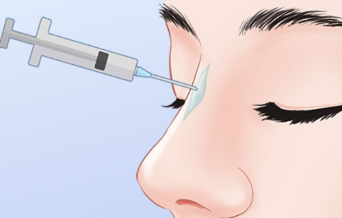 成都注射隆鼻牛的医生，山根塌陷、鼻头大都有救了，技术太绝！插图