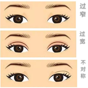 成都谭超医生怎么样？眼修复经验丰富，术后效果自然插图1