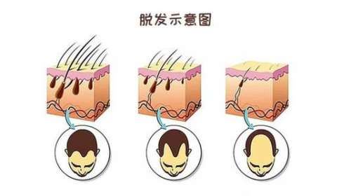 测评|西安植发医生哪个好？交大一附院赵文伟、二附院谭宣丰、星美的冀宝…插图