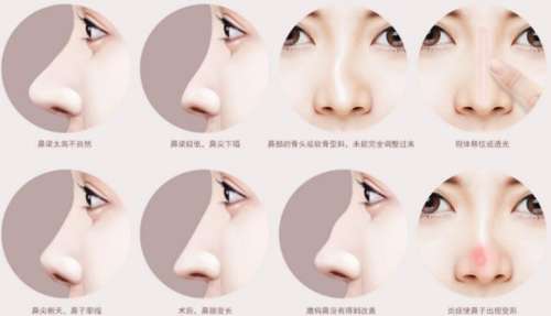广州艺星佘高明简介-鼻部整形博士-真的能让鼻子”妈生感”拉满！插图1