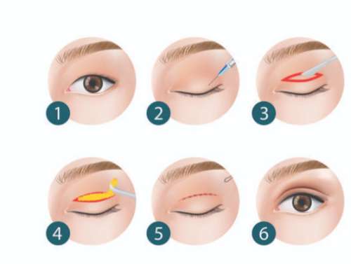 福州微创重睑术医生林建鸿怎么样？坐诊信息、适应人群！插图1