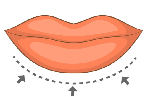 潘柏林医生唇部手术案例：从术前设计到术后恢复，全流程细节解析插图