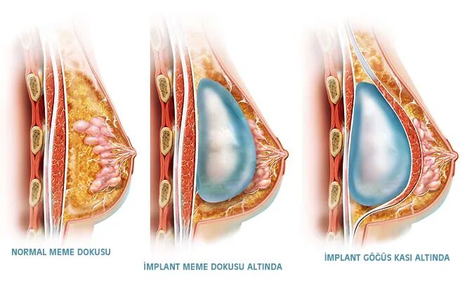 假体隆胸后还能喂奶吗？专家说实话插图