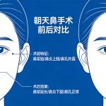 朝天鼻整形手术介绍与风险，如何打造自然立体鼻型