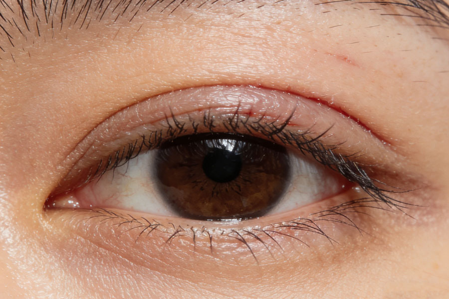 开眼角整形手术注意事项和效果分析|打造明亮双眼的秘诀插图1