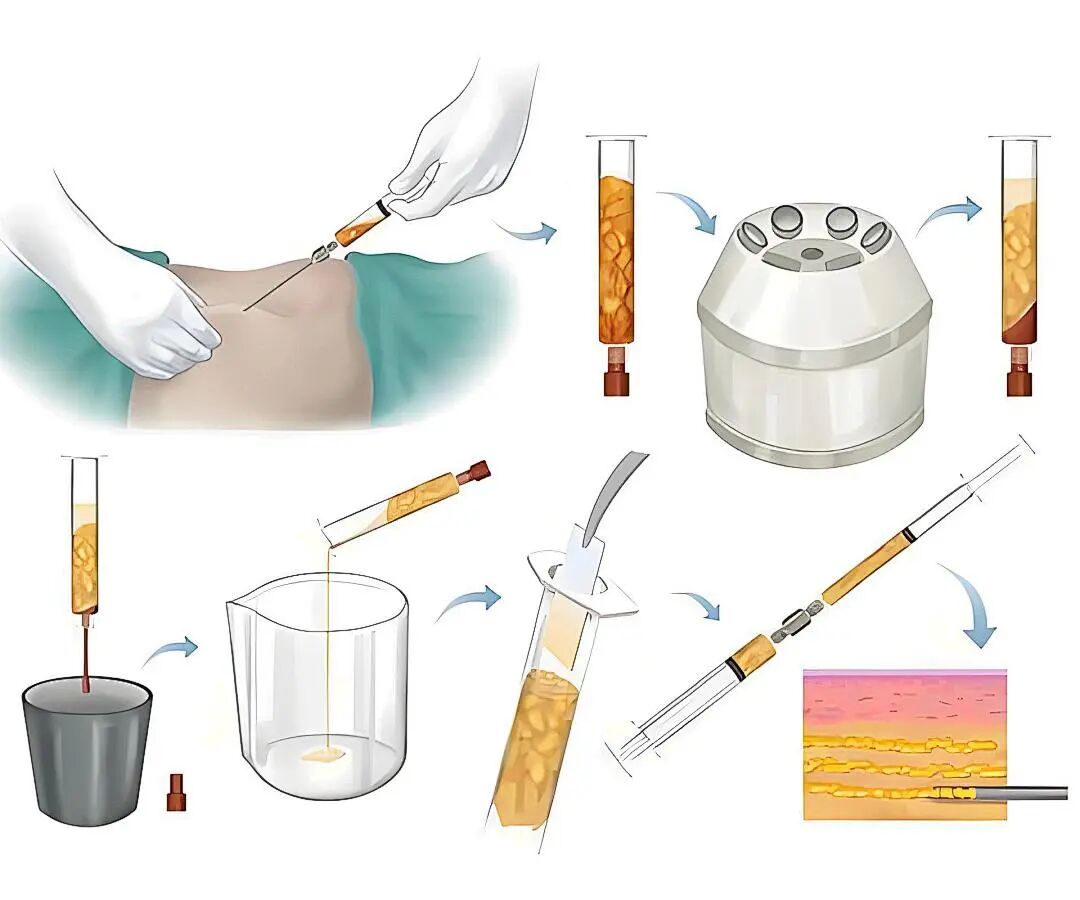 自体脂肪移植隆胸(自体脂肪移植隆胸有后遗症吗)插图1