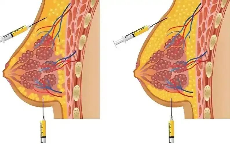 自体脂肪移植隆胸(自体脂肪移植隆胸有后遗症吗)插图