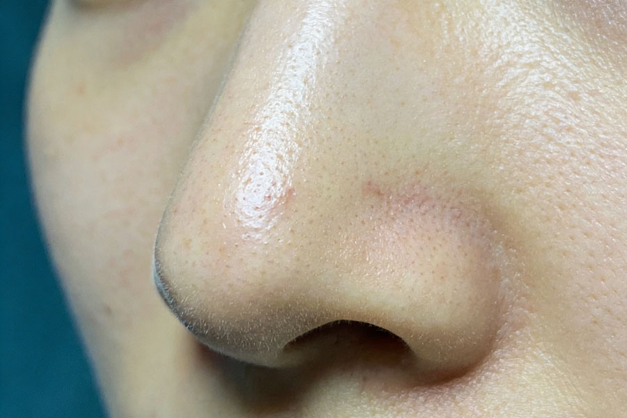 耳软骨、鼻中隔软骨、肋软骨，隆鼻到底该怎么选？插图