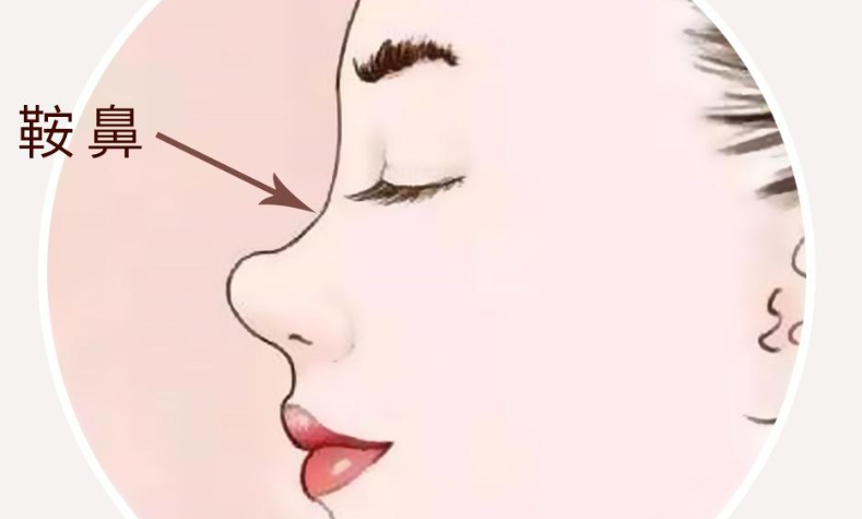 从“鞍”到“峰”：你的鼻子也可以拥有挺拔线条！插图