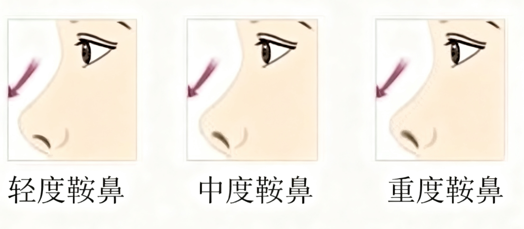 从“鞍”到“峰”：你的鼻子也可以拥有挺拔线条！插图1