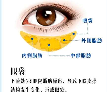西安去眼袋好的大夫有哪几位？柏宏亮、马显杰等技术值得信赖！插图3