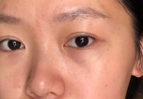 李秀琪眼袋案例分析插图1