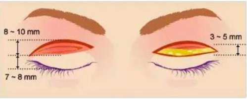 杭州王光建做眼修复怎么样?网友亲身经历分享!点击进来看插图2 杭州王光建做眼修复怎么样?网友亲身经历分享!点击进来看插图2