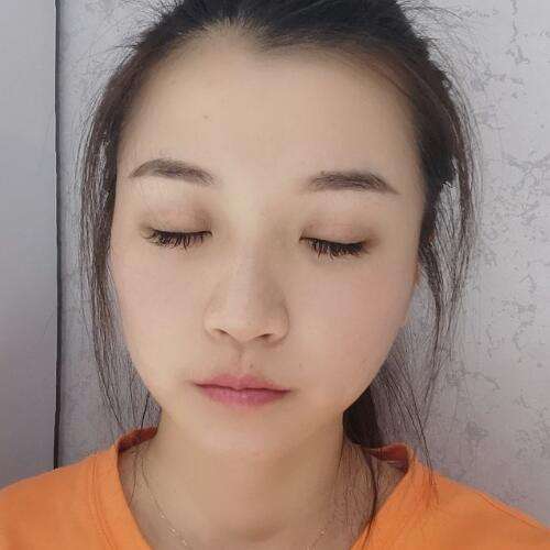 上海韩镜孙玉峰做双眼皮技术怎么样?双眼皮案例分析插图3 上海韩镜孙玉峰做双眼皮技术怎么样?双眼皮案例分析插图3