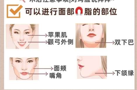 杭州面部吸脂哪个医生比较好?徐靖宏、谈伟强、张志宇实力强劲插图4 杭州面部吸脂哪个医生比较好?徐靖宏、谈伟强、张志宇实力强劲插图4