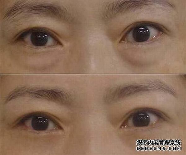 吸脂以及眼袋手术费用大概是多少?插图1