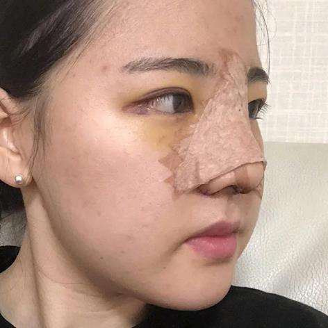 李劲良做鼻子对比案例分析插图1 李劲良做鼻子对比案例分析插图1
