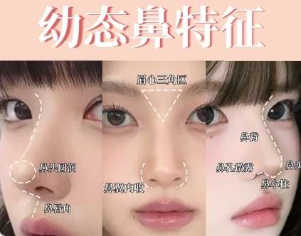 林金德医生做鼻子怎么样?术后状态自然吗?费用参考插图3 林金德医生做鼻子怎么样?术后状态自然吗?费用参考插图3