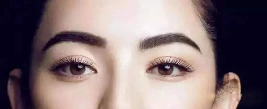 想做双眼皮手术？这些干货知识你要知道！插图