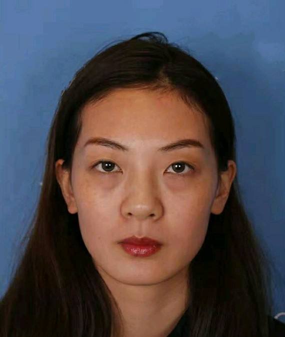 脂肪填充泪沟有什么注意事项？插图