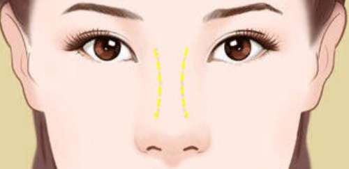 长沙希美肖阳医生口碑怎么样?医生实力测评|隆鼻案例分析插图3 长沙希美肖阳医生口碑怎么样?医生实力测评|隆鼻案例分析插图3