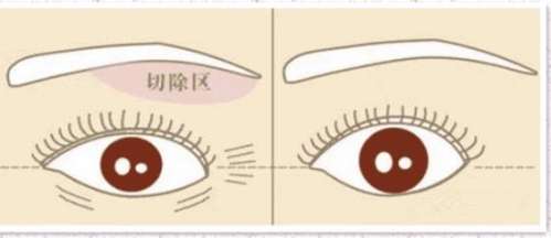 罗旭松做提眉手术怎么样？真实的手术案例分享！插图4