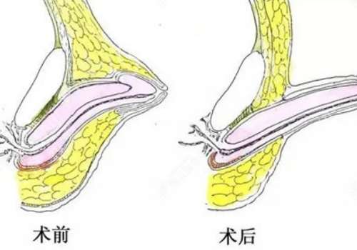重庆李世荣医生咋样?阴茎延长增粗专家,技术和价格曝光插图 重庆李世荣医生咋样?阴茎延长增粗专家,技术和价格曝光插图