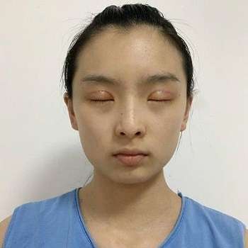 齐丙迪医生手术效果评价|技术怎么样?坐诊机构、双眼皮案例插图2 齐丙迪医生手术效果评价|技术怎么样?坐诊机构、双眼皮案例插图2