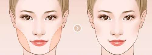 乔爱军面部吸脂怎么样?医生口碑测评|真人吸脂案例分析插图3 乔爱军面部吸脂怎么样?医生口碑测评|真人吸脂案例分析插图3