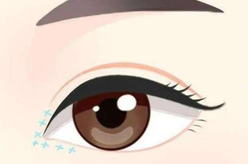 沈阳百嘉丽侯亚杰做的双眼皮好吗?技术靠谱吗?真实案例分析插图3 沈阳百嘉丽侯亚杰做的双眼皮好吗?技术靠谱吗?真实案例分析插图3