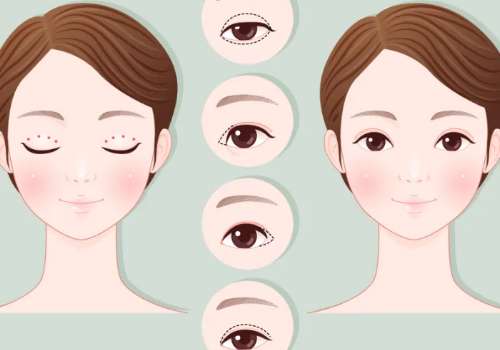 成都林靖割双眼皮口碑怎么样?技术测评+割双眼皮科普公布插图2
