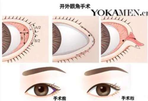 成都车红昌开外眼角需要多少钱?医生信息及最新价格公布插图2 成都车红昌开外眼角需要多少钱?医生信息及最新价格公布插图2