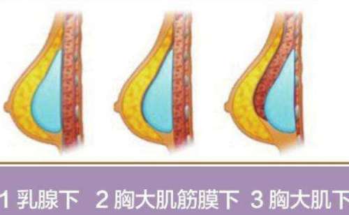 大连大学附属新华医院张晨隆胸技术级别怎么样?案例分析插图2 大连大学附属新华医院张晨隆胸技术级别怎么样?案例分析插图2