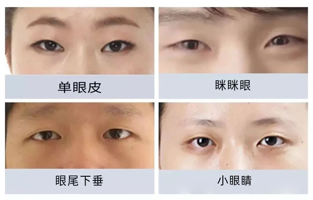 想做双眼皮手术？这些干货知识你要知道！插图1