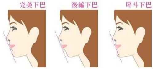 下巴后缩的调整方法都有哪些？你知道吗？插图