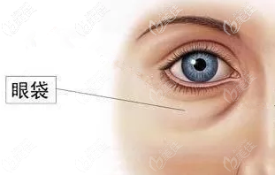 吸脂祛眼袋术后的注意事项，你了解吗？插图