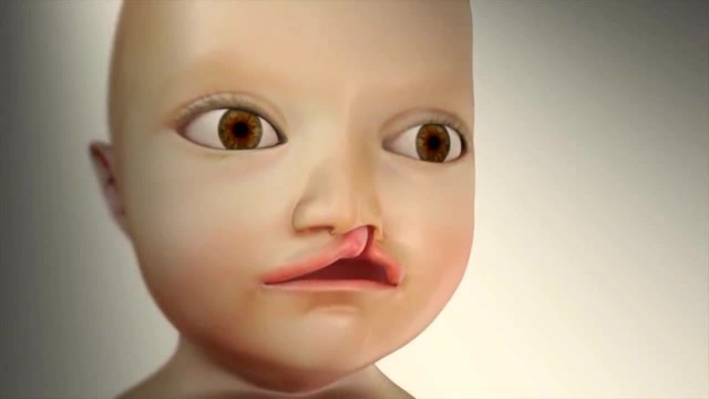 做了唇裂修复手术后该怎么护理？插图