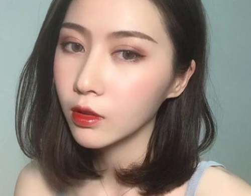 尹伟力医生双眼皮修复案例分析插图3 尹伟力医生双眼皮修复案例分析插图3