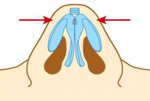 西安画美做鼻子医生哪位技术靠谱?李小正、张沙沙如何选择?插图3 西安画美做鼻子医生哪位技术靠谱?李小正、张沙沙如何选择?插图3