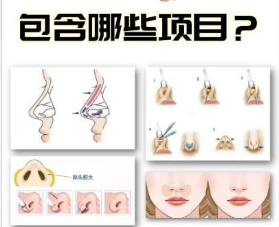 美贝尔童列健医生怎么样?做鼻子费用高吗?案例赏析插图3 美贝尔童列健医生怎么样?做鼻子费用高吗?案例赏析插图3